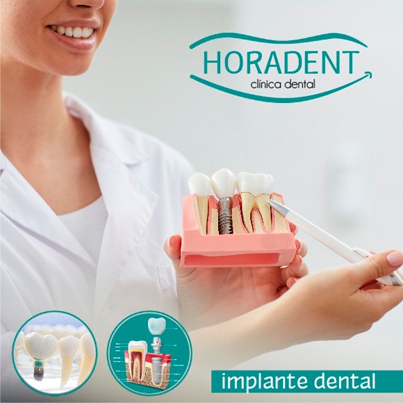 blog-implante-dental
